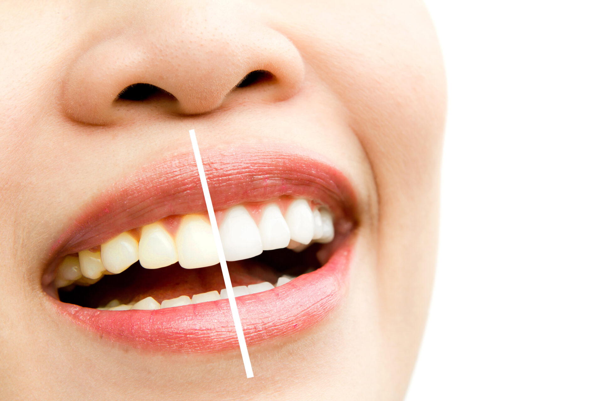 4 modi per sbiancare i tuoi denti